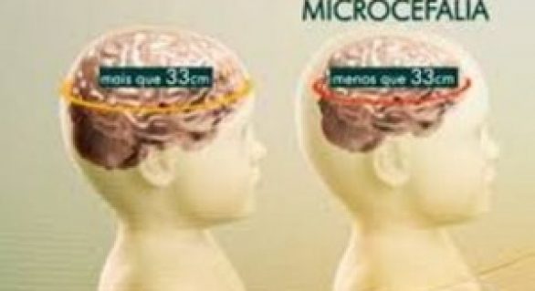 Sesau cria grupo técnico para acompanhar casos de microcefalia em AL