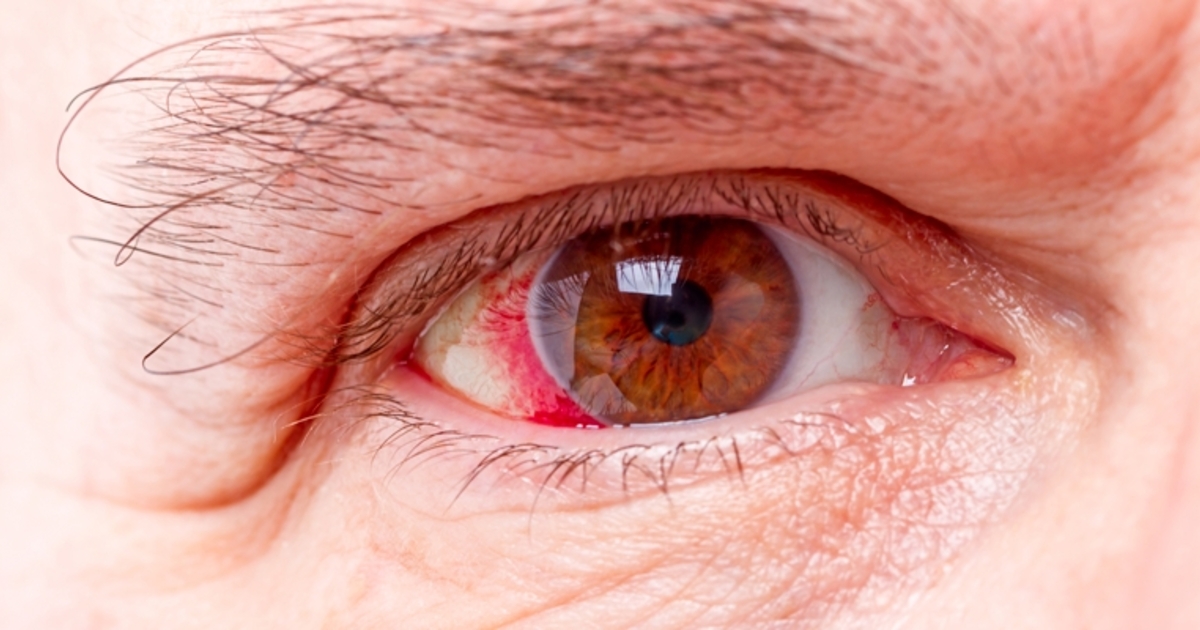 Milhares de alagoanos podem ficar sem tratamento para o Glaucoma